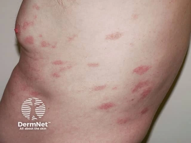 Multiple red, scaly patches with irregular borders scattered on the torso of a person with light skin, consistent with parapsoriasis.