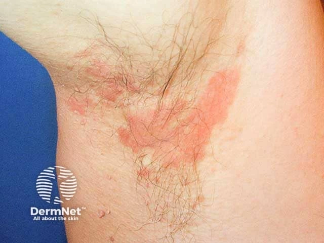 Pink-red, scaly patches with mild inflammation in the armpit of a person with light skin, characteristic of seborrheic dermatitis.