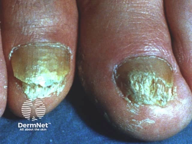 Thick, yellowish debris and scaling under the toenails with nail plate discoloration and irregularity, consistent with subungual hyperkeratosis on light skin.