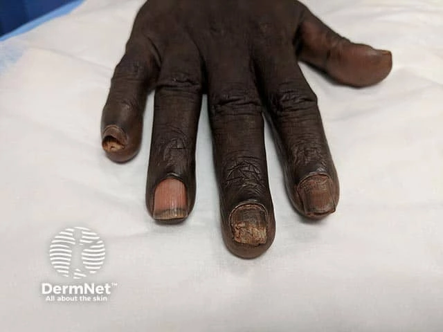 Thickened, brittle, and discolored fingernails with subungual debris and irregular nail surfaces on dark brown skin, characteristic of onychomycosis.
