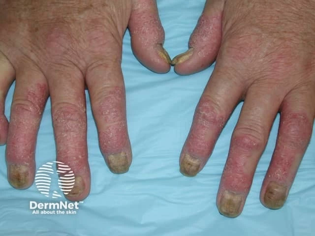Thickened, yellowish nails with pitting, onycholysis, and scaly erythematous plaques on the fingers of a person with light skin, characteristic of psoriatic arthritis.