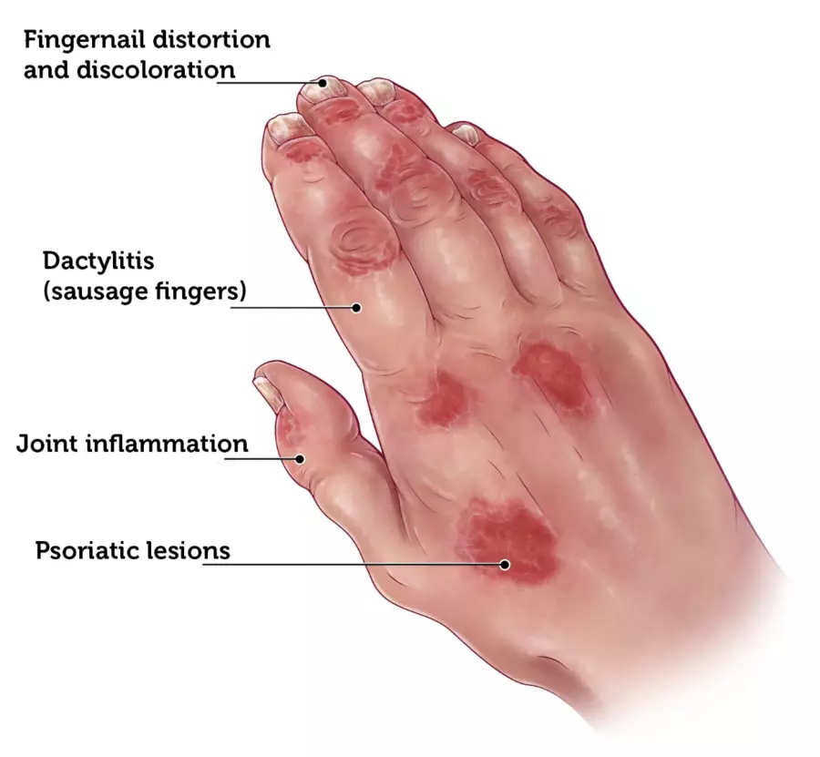 Swollen fingers, joint inflammation, fingernail discoloration, and red psoriatic plaques on the back of the hand, illustrating psoriatic arthritis on light skin.
