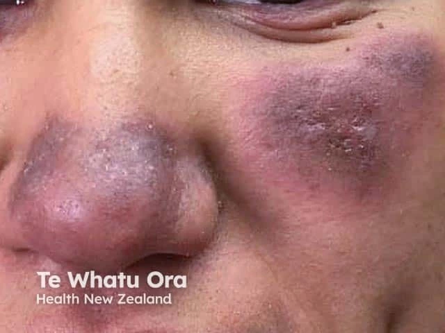 Dark purple, scaly, and slightly raised plaques on the cheeks and bridge of the nose of a person with medium skin tone, characteristic of discoid lupus erythematosus.