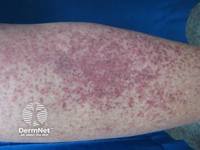 Close-up of a person’s lower leg showing many small, red and purple spots under the skin caused by bleeding. These spots, called petechiae, are a common sign of immune thrombocytopenia.
