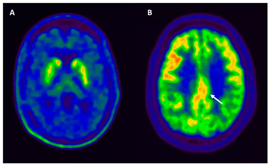 FDG-PET scans show reduced glucose metabolism in the occipital lobe, indicated by blue areas, characteristic of dementia with Lewy bodies.