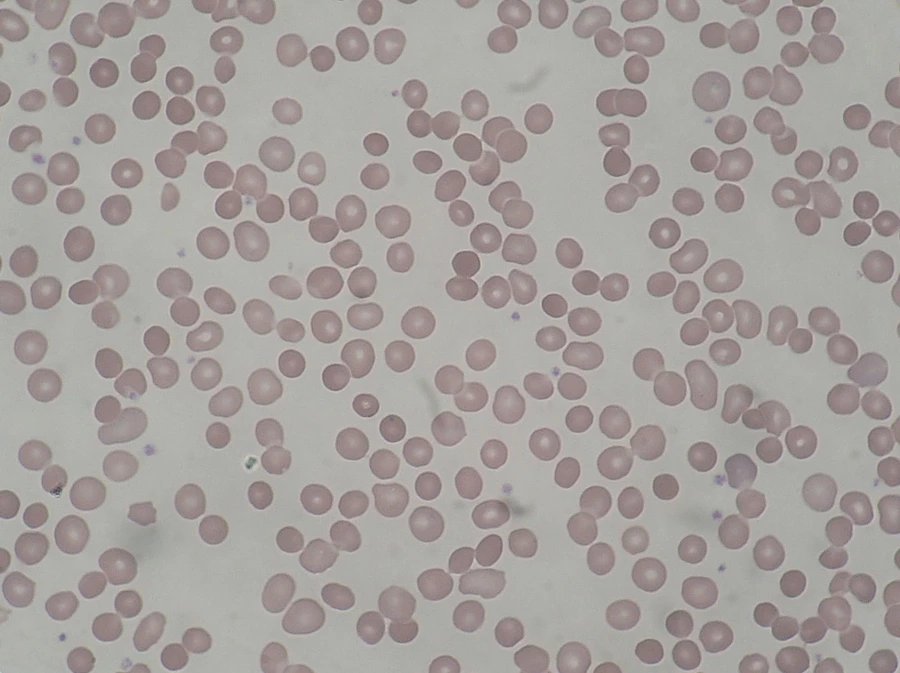 Microscopic image of red blood cells. Many appear round and dense without a pale center, showing a pattern called spherocytosis. This is typical of hereditary spherocytosis and other hereditary hemolytic anemias.