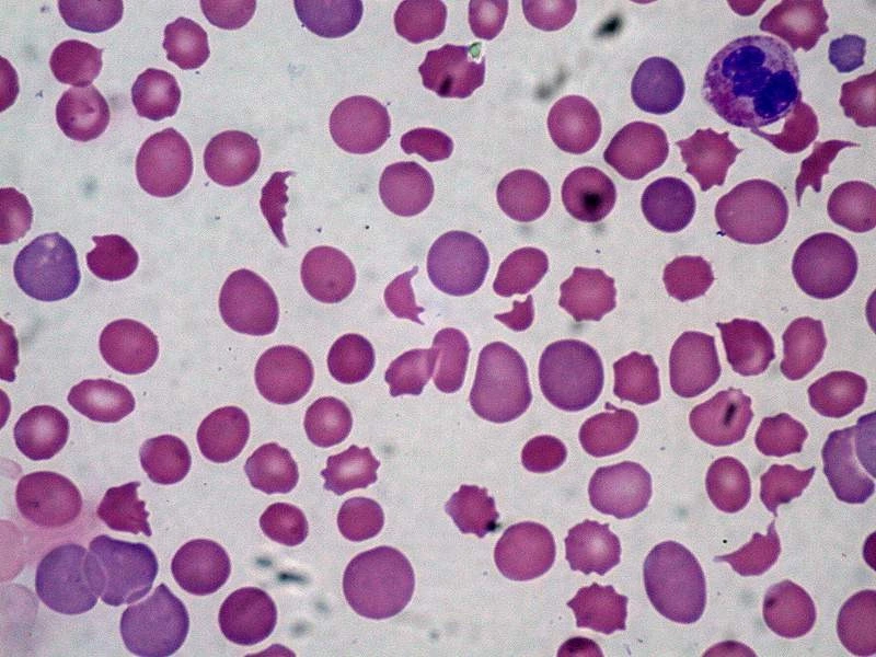 Peripheral blood smear with numerous fragmented red blood cells, including schistocytes and helmet cells, characteristic of microangiopathic hemolytic anemia.