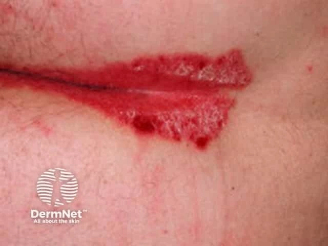 Well-defined, bright red, shiny plaques with minimal scaling in a skin fold of a person with light skin, characteristic of inverse psoriasis.