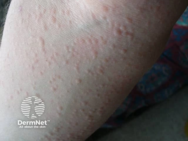 Numerous small, raised, red wheals clustered on the forearm of a person with light skin, characteristic of cold urticaria.