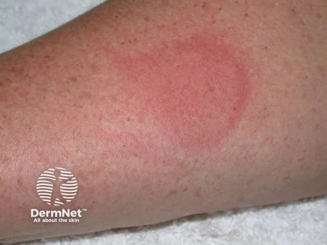 Well-defined, round, red wheal on the forearm of a person with light skin, consistent with a positive ice cube test for cold urticaria.