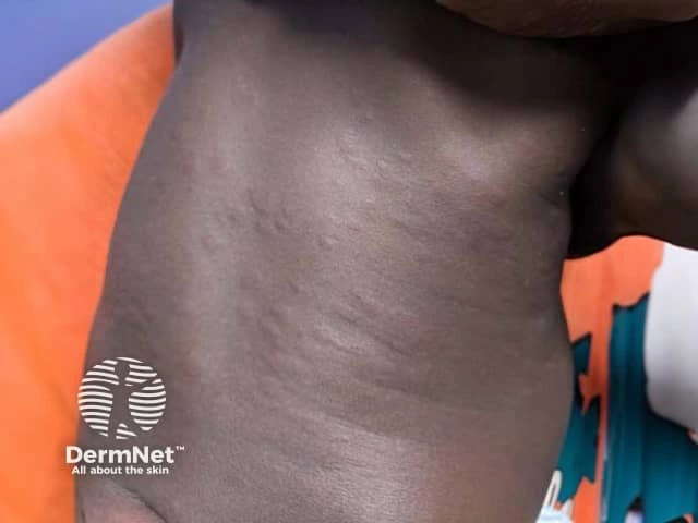 Slightly raised, swollen, skin-colored welts on the torso of a child with dark brown skin, consistent with hives.