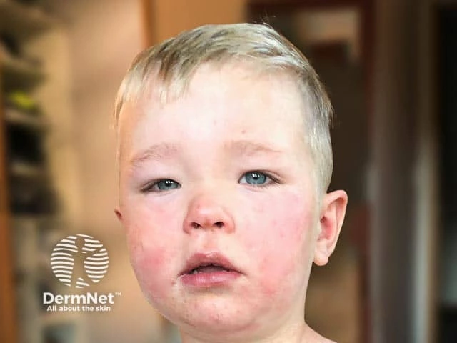 Facial swelling with redness and mild rash on the cheeks and around the eyes of a young child with light skin, consistent with angioedema.