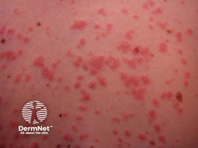Numerous small, red, scaly teardrop-shaped plaques scattered on light skin, characteristic of guttate psoriasis.