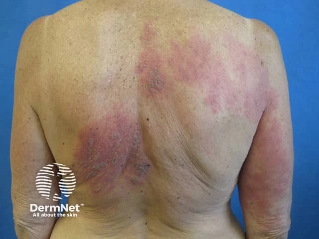 Large, irregular red patches with mild scaling on the upper and lower back of a person with light skin, consistent with a widespread shingles (herpes zoster) rash.