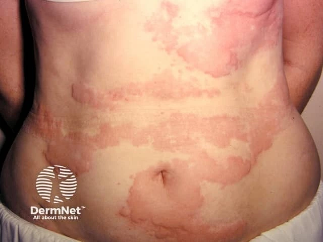 Widespread, irregular, pink and red raised patches on the lower back and abdomen of a person with light skin, consistent with chronic urticaria.