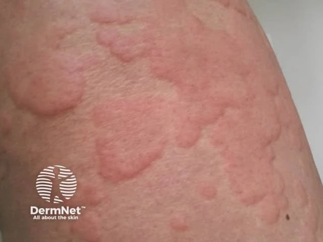 Raised, pink, irregularly shaped welts on the upper arm of a person with light skin, typical of urticaria (hives)