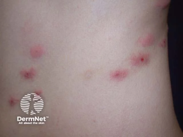 Multiple red, itchy, inflamed bumps in a linear pattern with some central puncture marks on light skin, characteristic of bed bug bites.