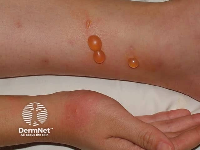 Large, fluid-filled blisters and surrounding redness on the lower leg and ankle of a person with light skin, consistent with a severe reaction to insect bites.
