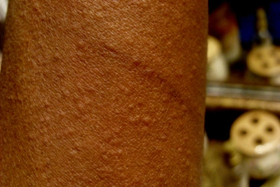 Multiple small, raised, flesh-colored bumps scattered across the forearm of a person with dark brown skin, characteristic of cholinergic urticaria.