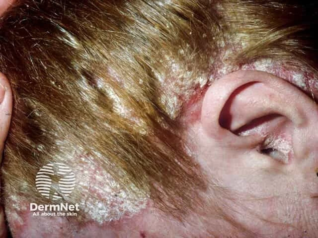 Thick, yellowish-white, asbestos-like scales covering large areas of the scalp with underlying redness and inflammation on light skin, characteristic of severe scalp psoriasis with pityriasis amiantacea.