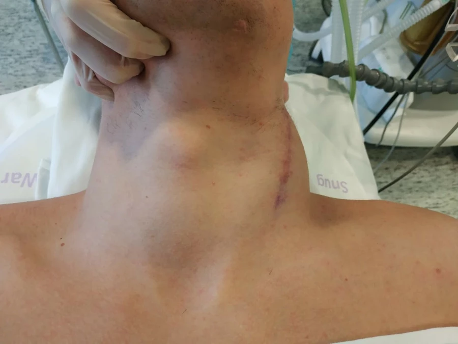 Firm, irregular swelling on the left side of the neck with a faint surgical scar on light skin, consistent with a desmoid tumor in the cervical region.