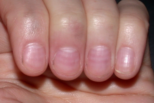 Multiple horizontal white lines across the fingernails on light skin, consistent with Muehrcke's lines.