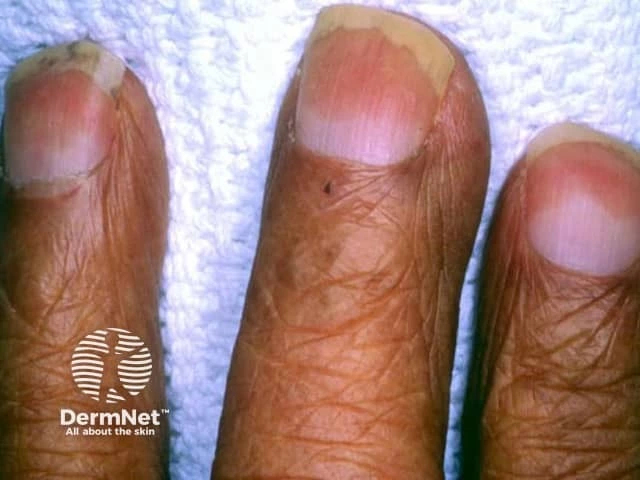Fingernails on dark brown skin with a distinct proximal white half and a sharply demarcated distal brown band, characteristic of half-and-half nails (Lindsay’s nails).