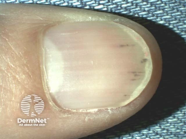 Multiple thin, reddish-brown vertical lines under the fingernails on light skin, consistent with splinter hemorrhages.