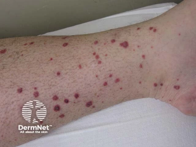 Numerous red to purple raised spots scattered over the lower leg of a person with light skin, consistent with palpable purpura.