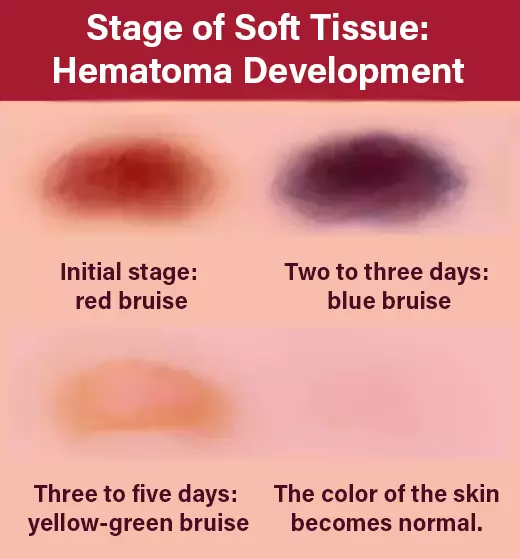 Progression of a bruise on light skin from red (initial stage) to blue (two to three days) to yellow-green (three to five days), then returning to natural skin color as healing completes.