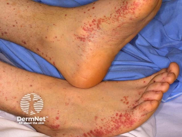 Numerous non-blanching red-purple spots and patches on the feet and lower legs of a person with light skin, characteristic of purpura.