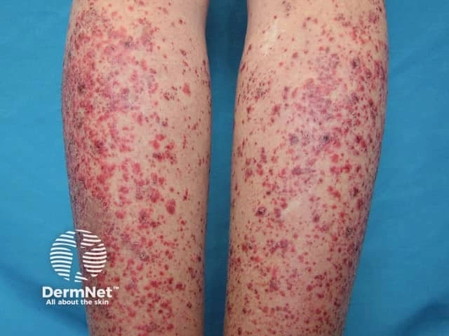 Numerous red and purple spots and patches on the lower legs of a person with light skin, consistent with vasculitis associated with Sjögren’s syndrome.