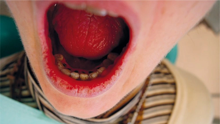 Smooth, glossy, red tongue lacking normal papillae in a person with Sjögren’s disease and light skin.