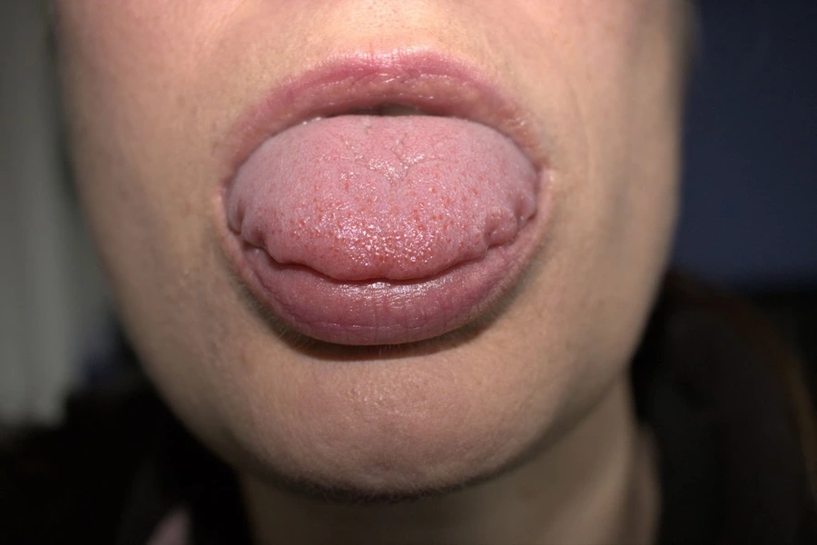 Enlarged tongue with wavy or scalloped indentations along the edges in a person with light skin.