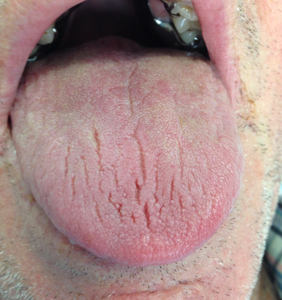 Deep fissures and a dry, rough surface on the tongue of a person with light skin, consistent with xerostomia (dry mouth).