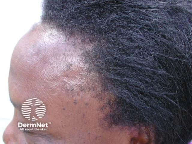 Patchy hair loss and thinning along the frontotemporal hairline with small perifollicular bumps and scarring changes, characteristic of traction alopecia on dark brown skin.