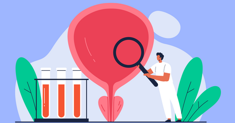 How Fast Does Bladder Cancer Spread? | MyBladderCancerTeam