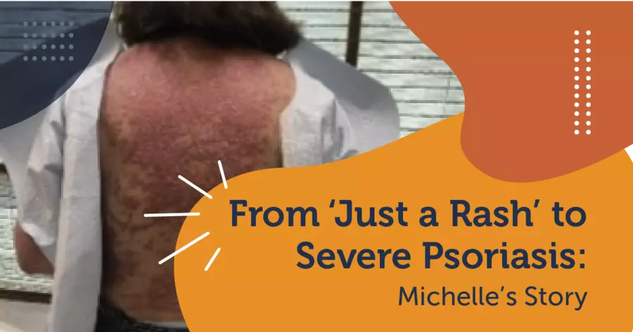 From ‘Just a Rash’ to Severe Psoriasis: Michelle’s Story (VIDEO ...