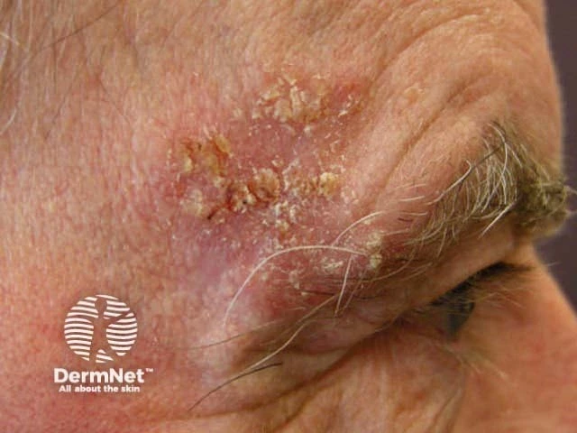 Crusted, scaly pink plaque above the eyebrow of a person with light skin, with surface erosion and hyperkeratosis, consistent with squamous cell carcinoma.