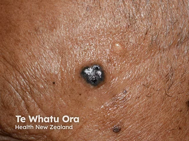 Shiny, dark pigmented raised nodule with a smooth surface on the face of a person with dark brown skin, consistent with pigmented basal cell carcinoma.