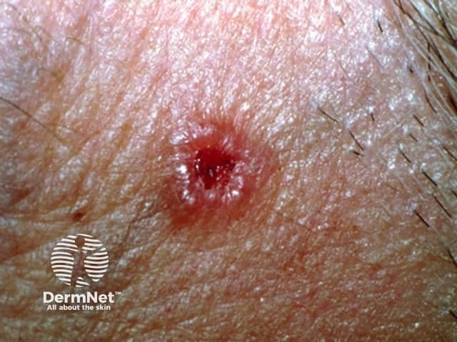 Small, shiny pink-red nodule with a central ulcer on light skin, characteristic of nodular basal cell carcinoma.