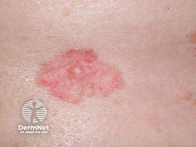 Thin pink scaly plaque with a slightly raised border on the trunk of a person with light skin, consistent with superficial basal cell carcinoma.