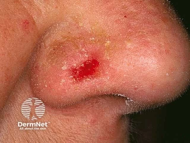 Small open sore with central bleeding and a slightly raised border on the side of the nose of a person with medium skin tone, consistent with basal cell carcinoma.