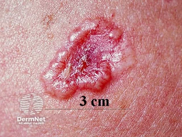 Pink, shiny ulcerated plaque with a raised rolled border on light skin, characteristic of basal cell carcinoma. Scale marker shows the lesion is about 3 cm wide.