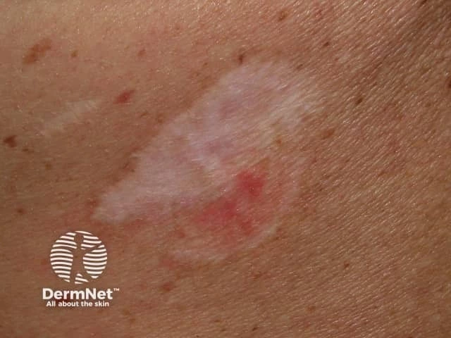 Pale scarlike patch with a faint pink area on light skin, characteristic of morpheaform basal cell carcinoma.