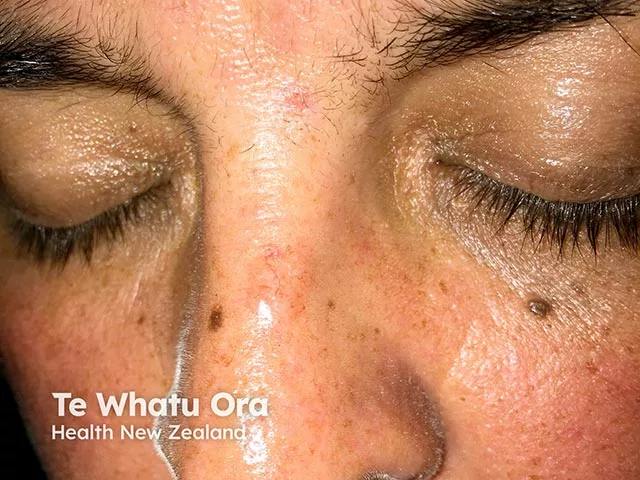 Small, shiny papule on the side of the nose of a person with medium skin tone, with visible angulated telangiectatic vessels, consistent with basal cell carcinoma.