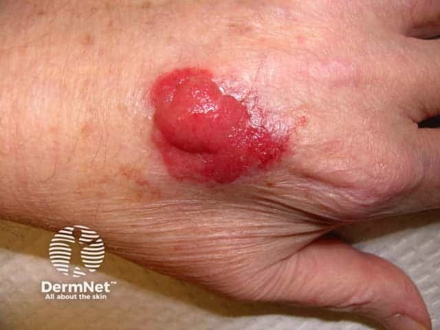 Lobulated pink-red nodular lesion with focal ulceration on the back of the hand of a person with light skin, consistent with nodular ulcerated basal cell carcinoma.