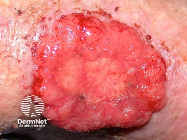 Large, ulcerated pink-red tumor with a lobulated surface and visible blood vessels on light skin, consistent with advanced basal cell carcinoma.