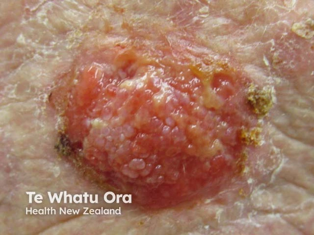 Pink-red nodular skin tumor with a rough keratotic surface and small crusted ulcerations on light skin, consistent with high-risk cutaneous squamous cell carcinoma.