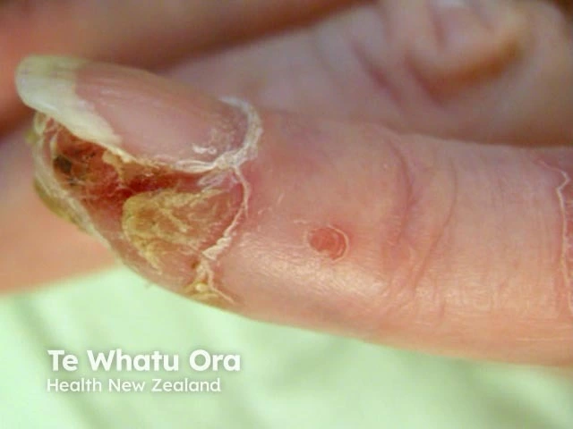 Crusted, hyperkeratotic lesion beneath the fingernail with a small round pink papule on the finger of a person with light skin, consistent with intraepidermal squamous cell carcinoma.
